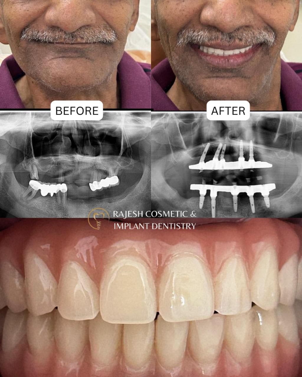 Full arch implant rehabilitation