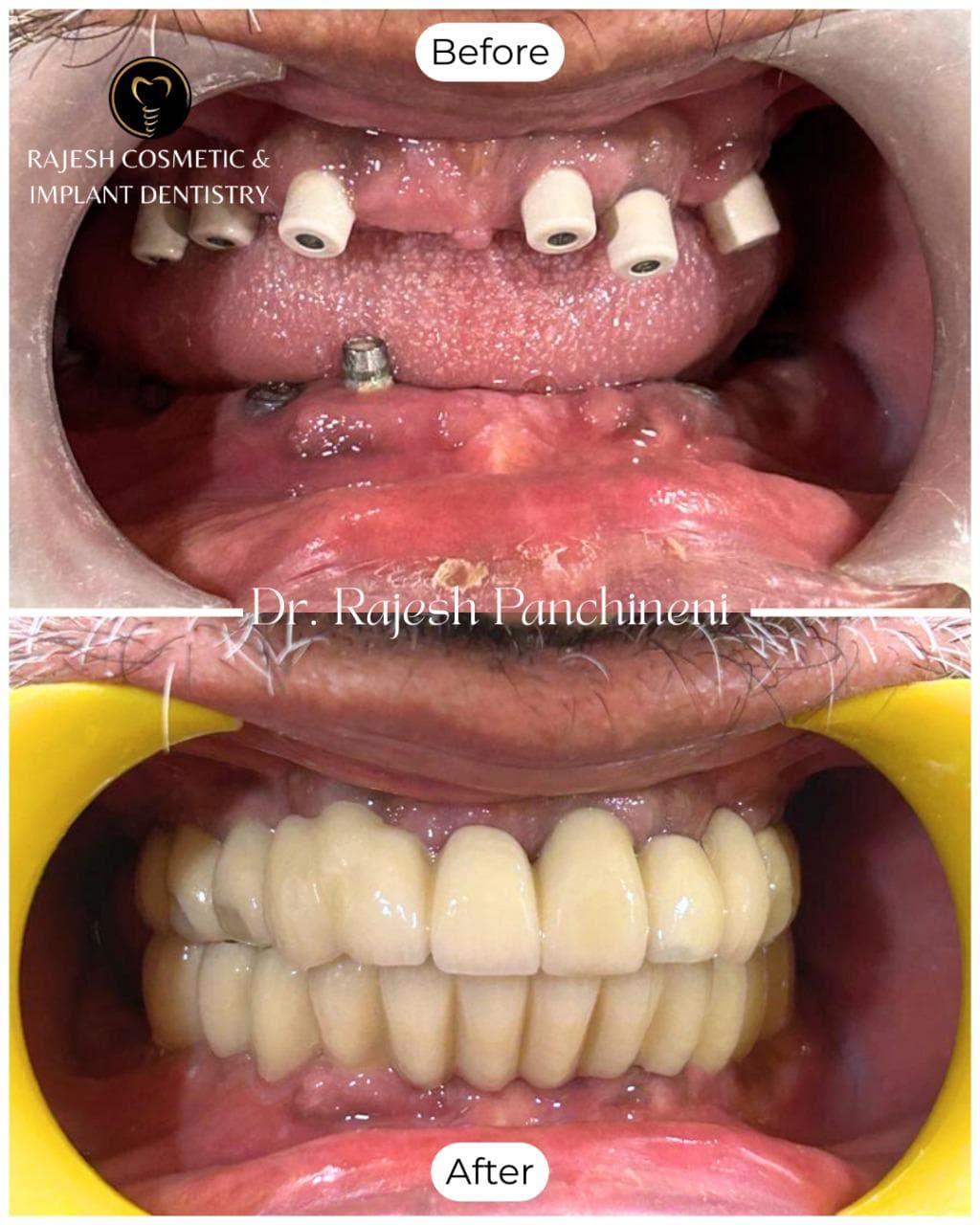 Dental implant clinical case