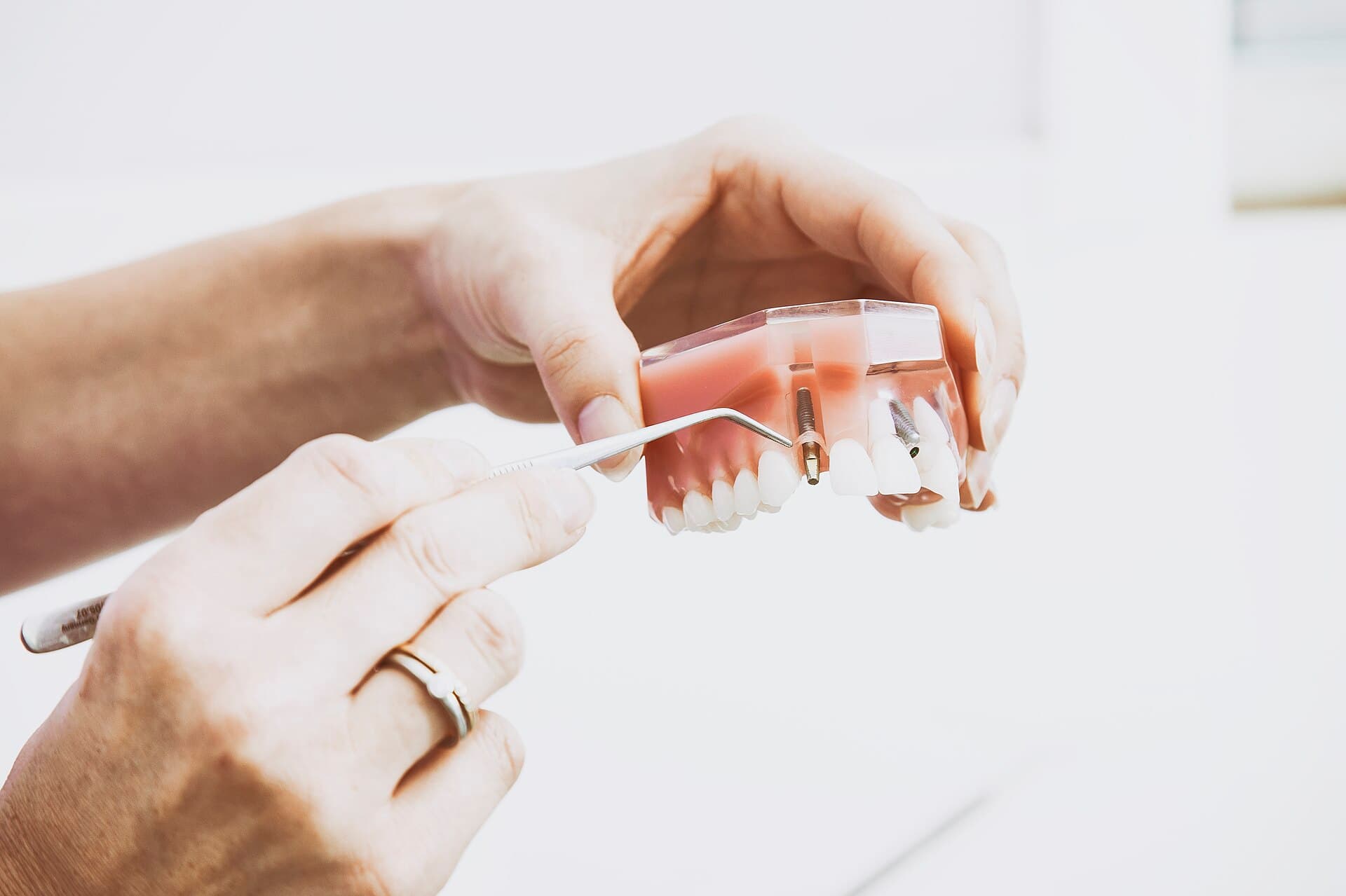 Precision titanium dental implant fixture and custom ceramic crown restoration model demonstrating permanent tooth replacement at Rajesh Dental Bengaluru