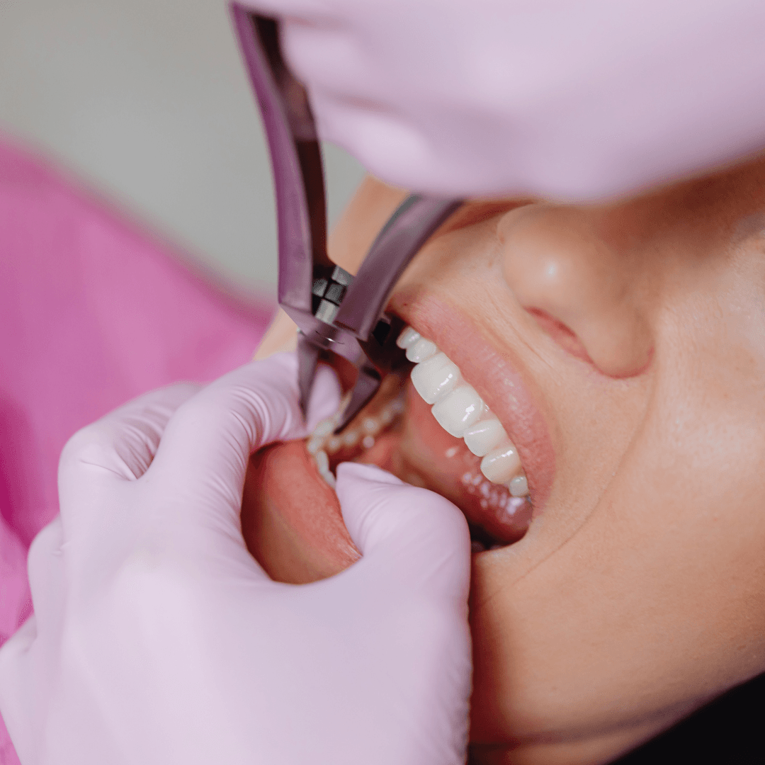 Full Mouth Rehabilitation for Acid Erosion