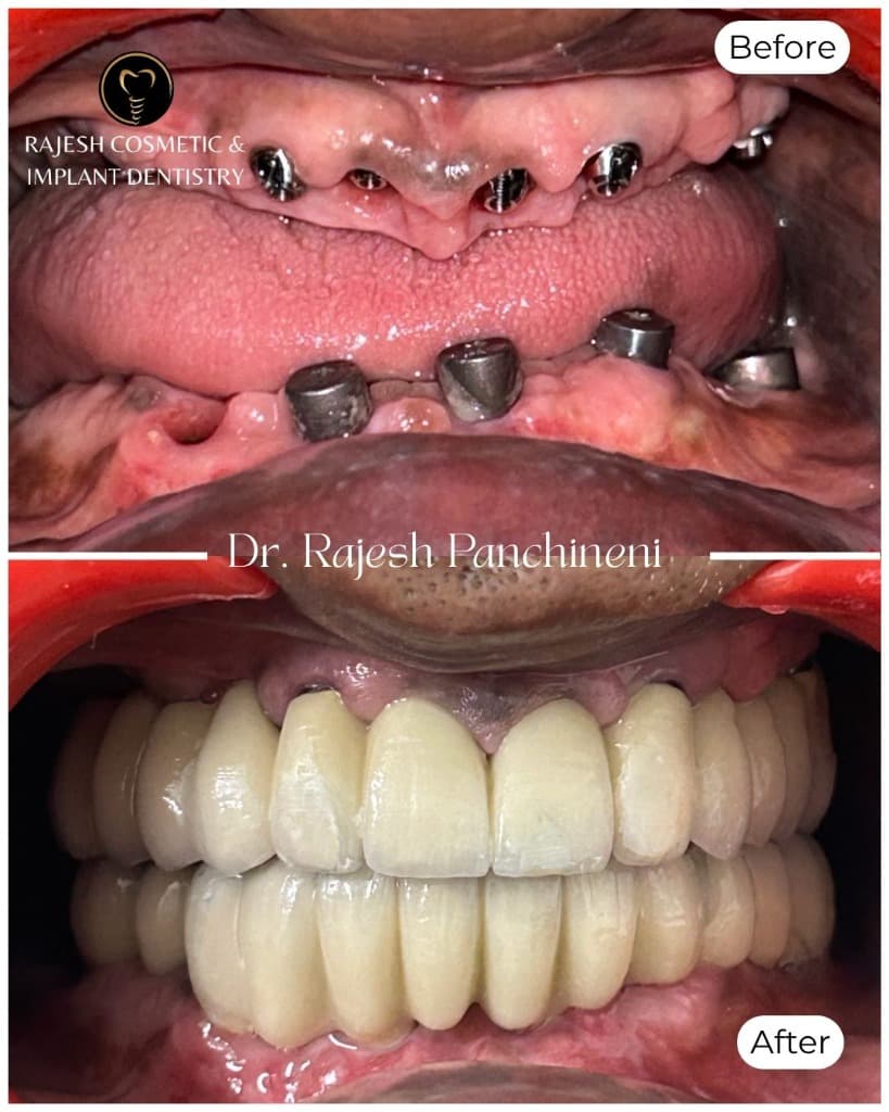 Before and after full mouth dental rehabilitation: multi-unit dental implant abutments on upper and lower arches transformed with fixed full-arch zirconia prosthesis by Dr. Rajesh Panchineni in Bengaluru