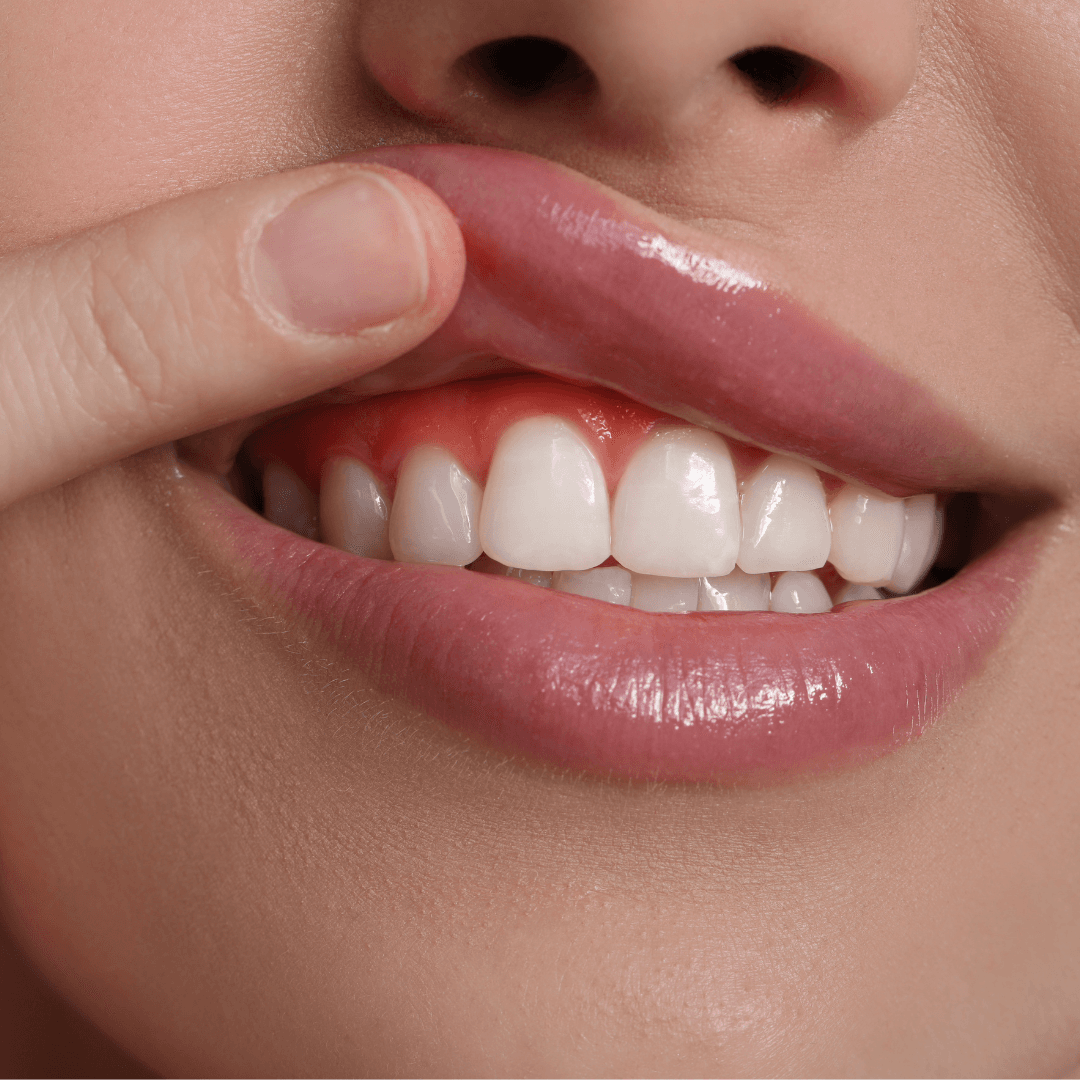 Gum Treatment for Bleeding Gums