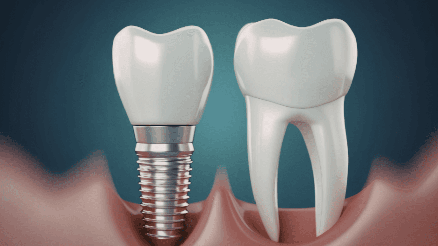 Dental Implants