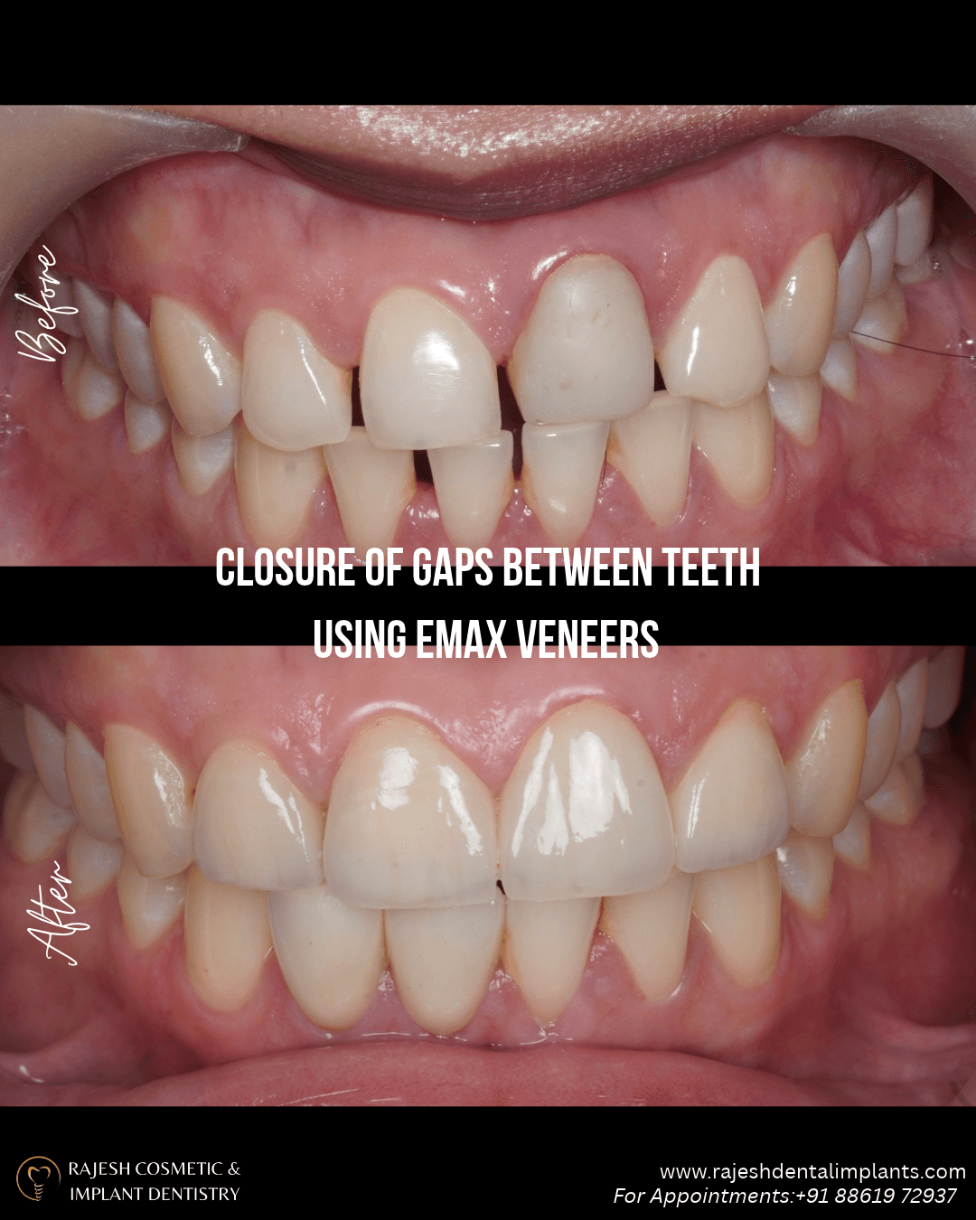 Clinical before and after: diastema and gap closure between upper front teeth using ultra-thin E.max porcelain veneers by cosmetic dentist Dr. Rajesh Panchineni