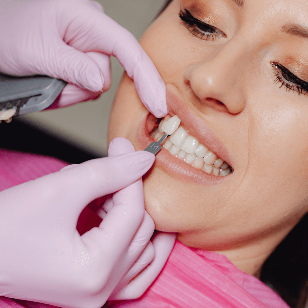 Cosmetic dentist using dental shade guide tabs to precisely match custom porcelain veneer tooth colour to patient's natural smile
