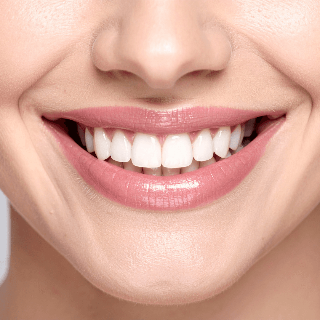Teeth Whitening