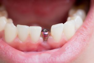 Benefits-of-Single-Tooth-Dental-Implants