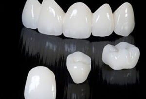 dental-crown-and-bridge-budapest-300x252