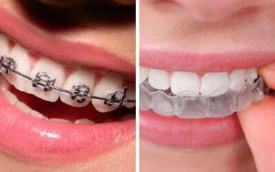 The Perfect Time for Braces: Ensuring Your Child’s Radiant Smile and Oral Health