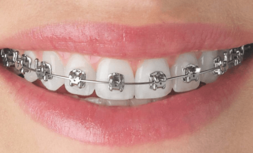 Orthodontic treatments in bangalore
