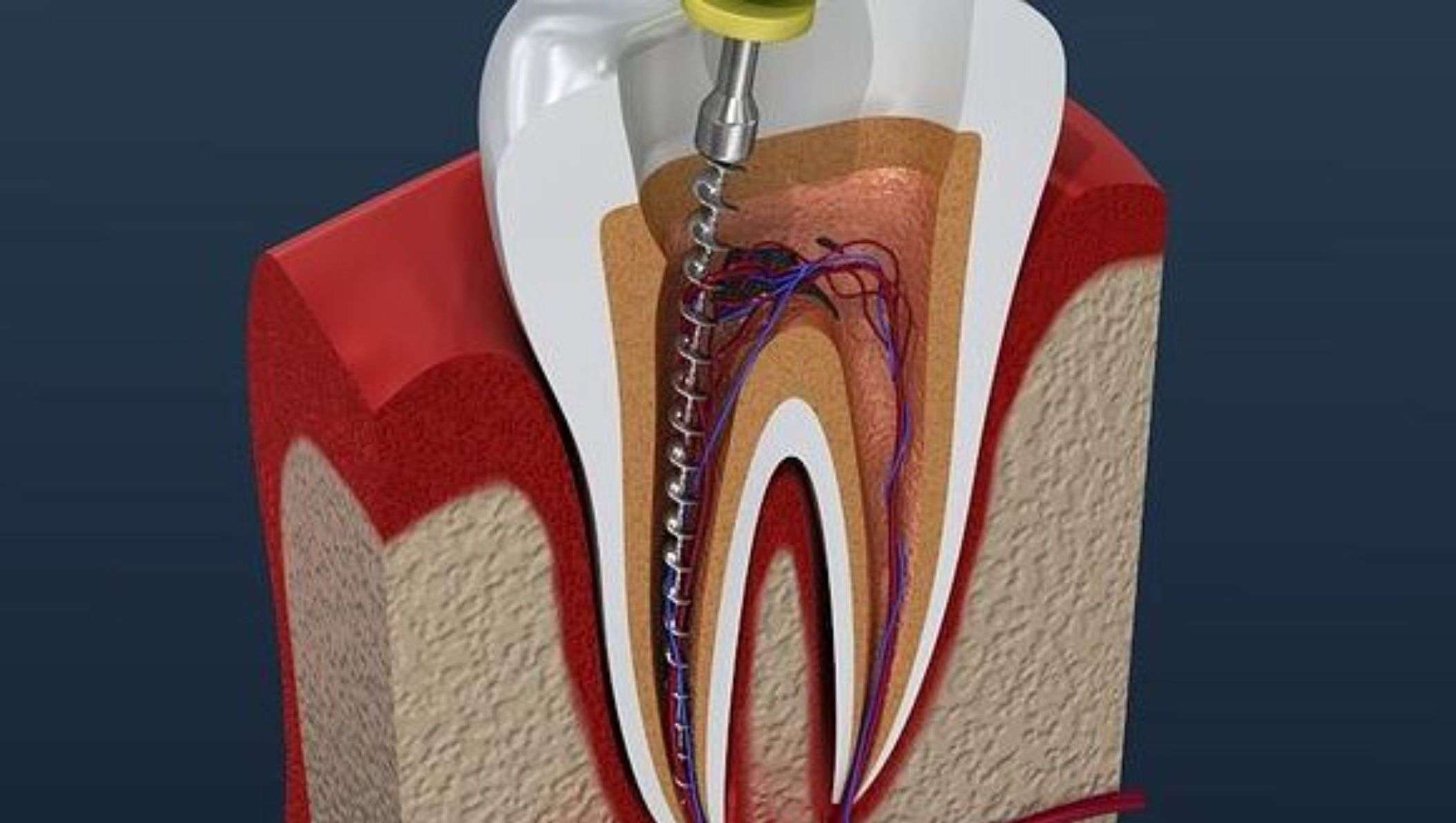 root canal treatment bangalore