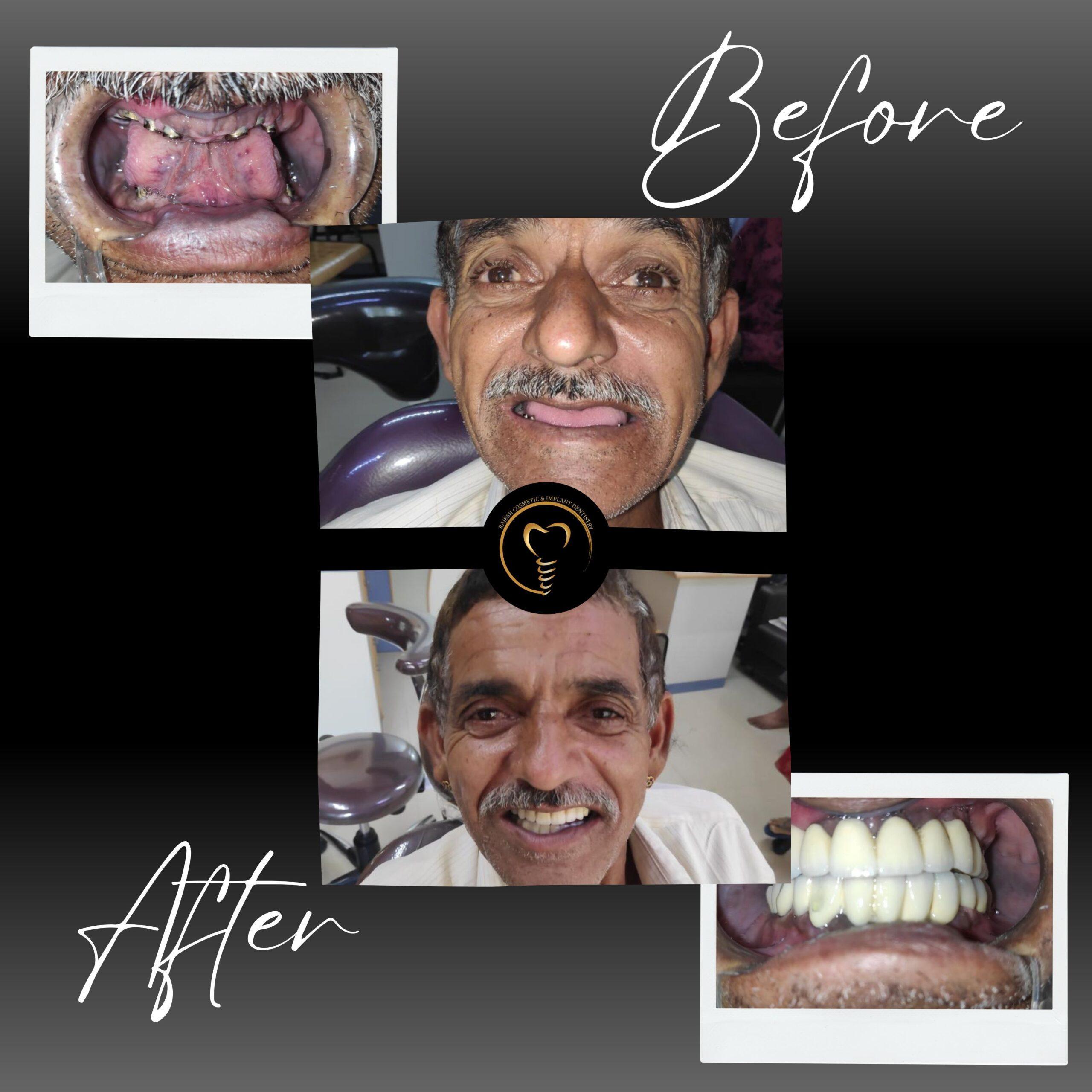 Tooth restoration Bangalore