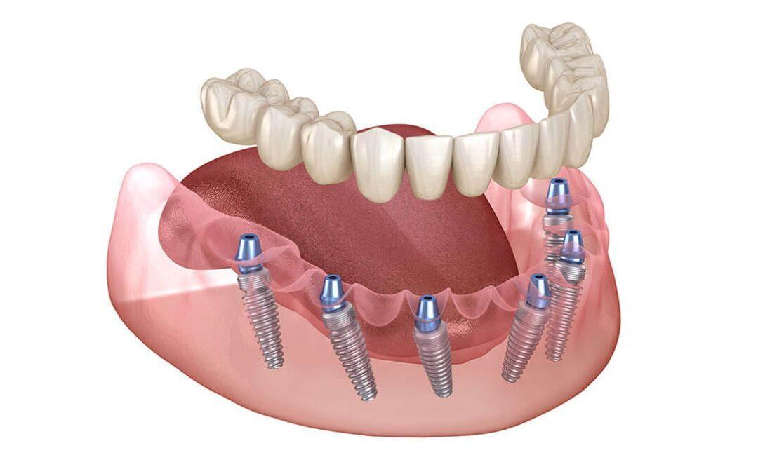 What is All on 6 Dental Implants?