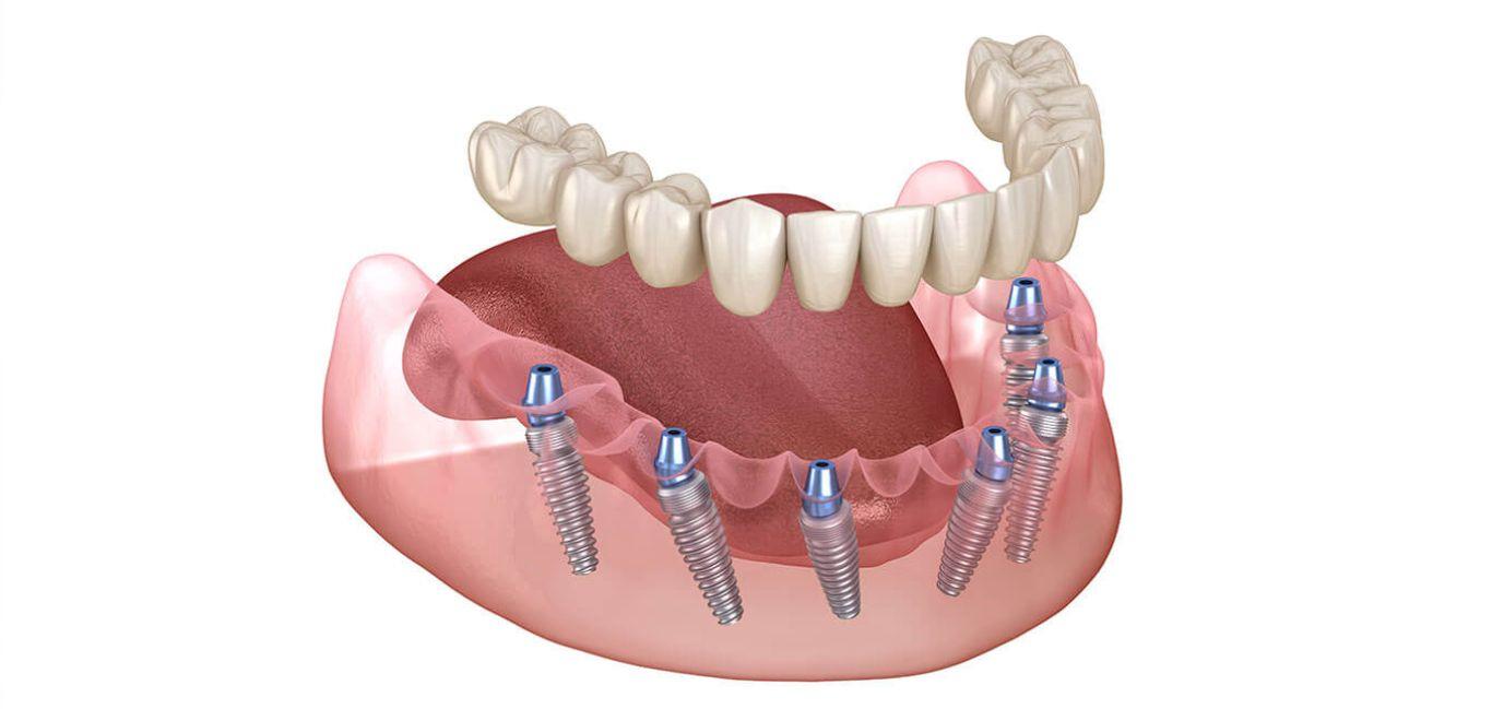 all-on-6-dental-implants-banner-the-dental-roots