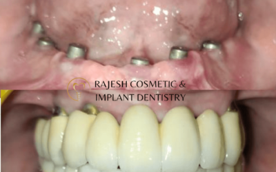 Dental Tourism in India: A Smart Choice for World-Class Care at Global Value