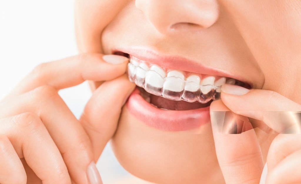 wmremove-transformed Invisalign in Bangalore